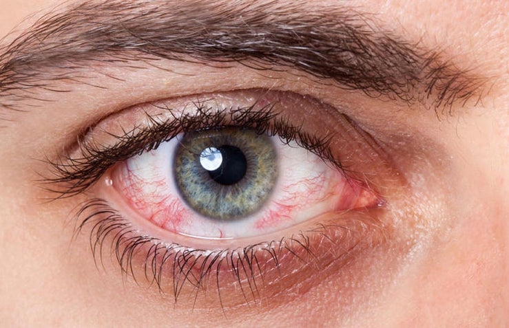 Dry Eye – Which Drops Do I Use?