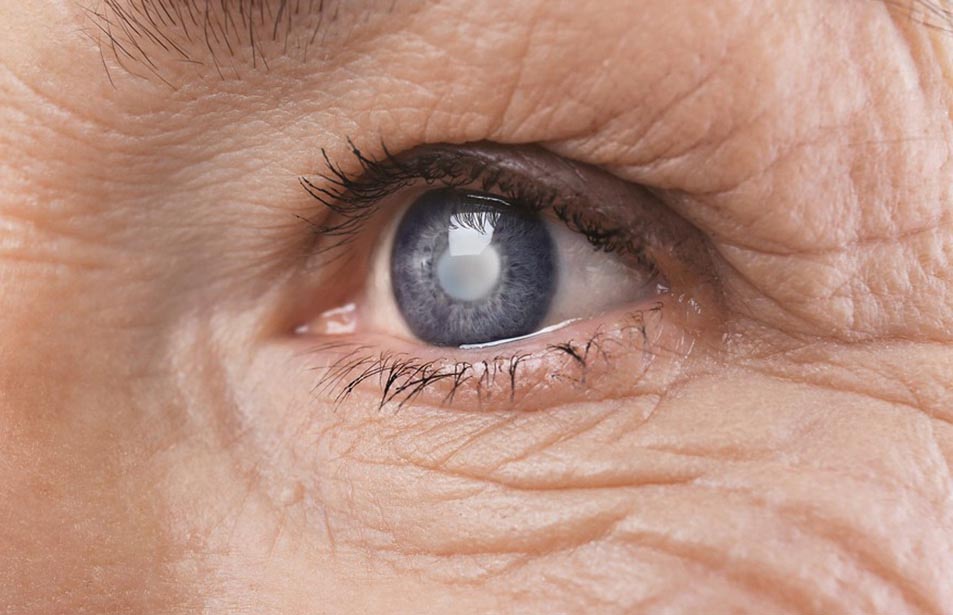 Time To Stop Avoidable Blindness In Diabetes